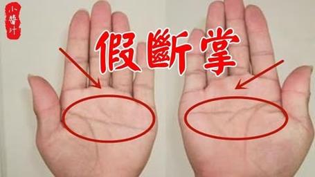 女人右手假断掌的命运