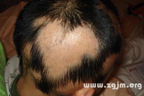 男人梦见掉头发