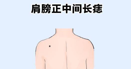 右肩痣的位置图