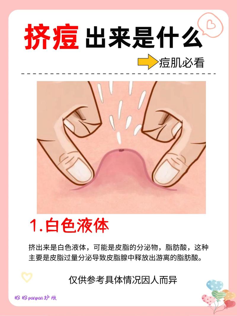 梦到自己挤痘痘挤出一大坨有什么征兆
