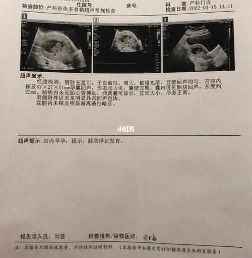 孕妇梦见死鱼后胎停,孕妇梦见死鱼胎会死腹中吗
