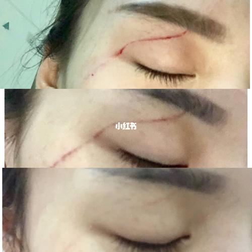 后天形成的疤影响命运吗