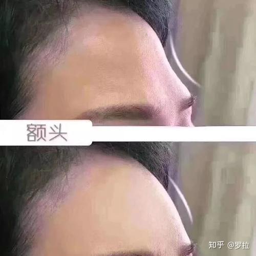 额头饱满与不饱满对比