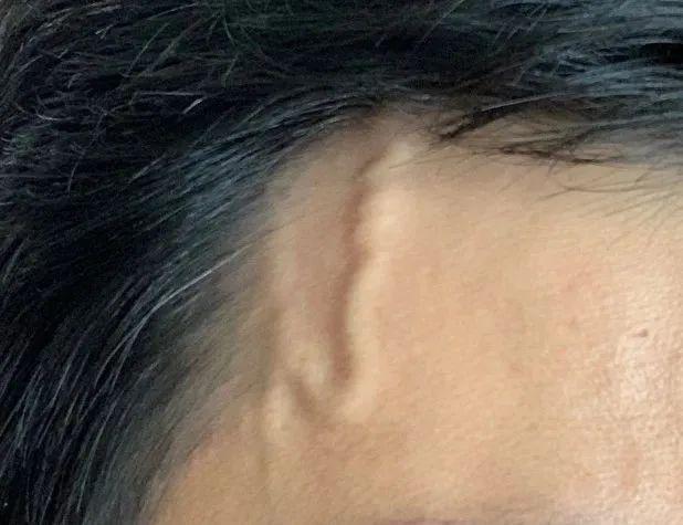 额头上爆青筋是好是坏?