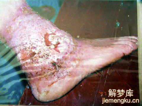 梦见别人流脓