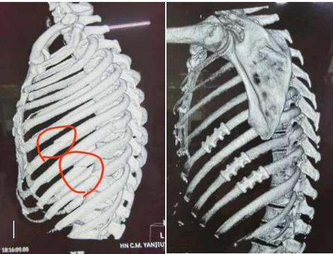 梦见肋骨断了一根