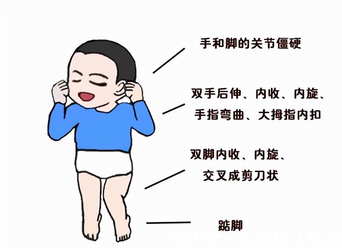 7种方式判断是不是脑瘫