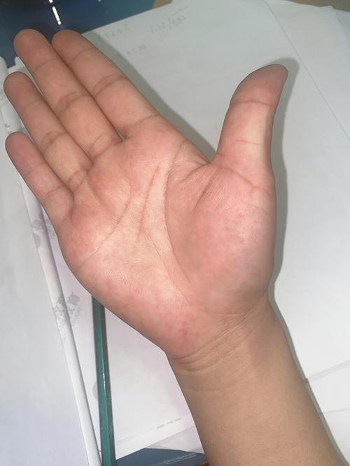 川字纹是劳苦纹的一种吗
