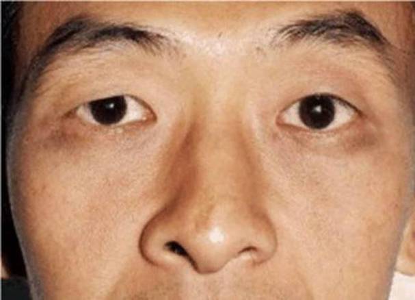 男人鼻孔外露面相