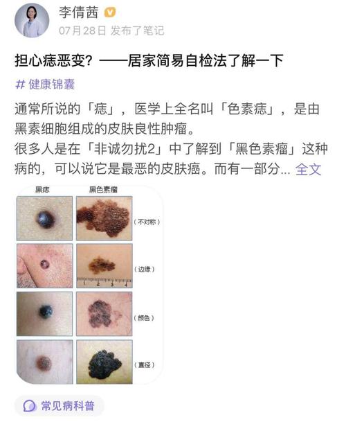痣病变有什么症状解析!