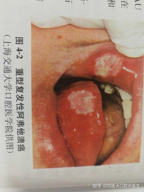梦见溃疡周公解梦,梦见溃疡是什么意思?