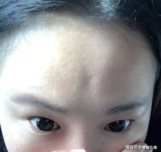 印堂后天造成疤痕面相怎么样