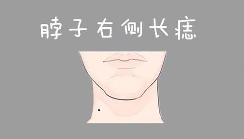 男人脖子左侧有痣是好的吗