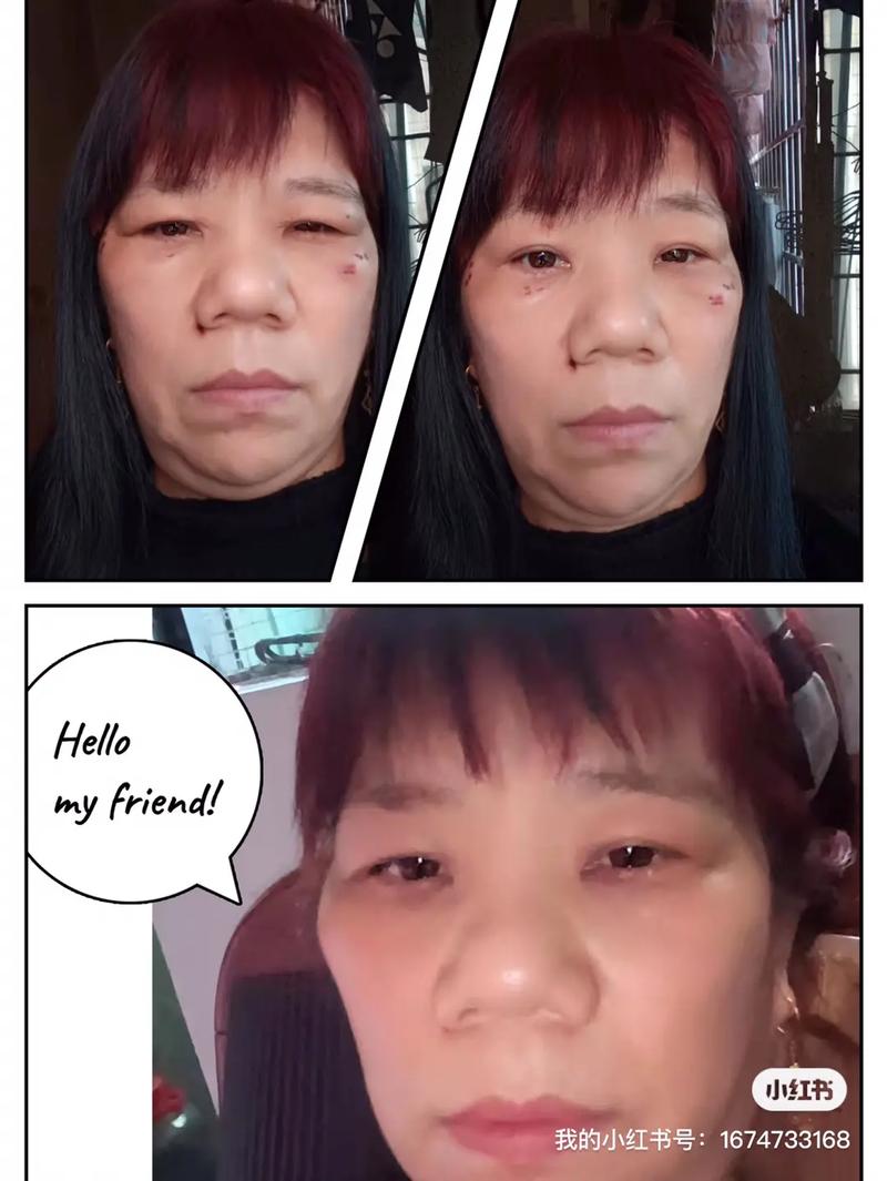 祛痣哪些地方不能取