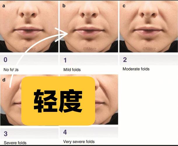 嘴角有八字纹怎么解决