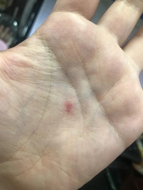 胎记算命准吗 八字怎么看胎记