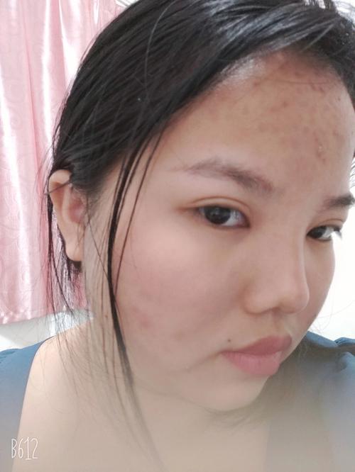 鼻梁塌陷容易影响家运是真的吗