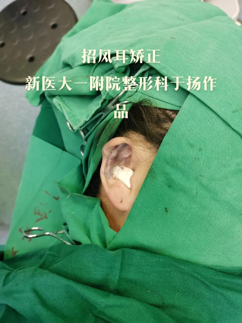 招风耳怎么纠正