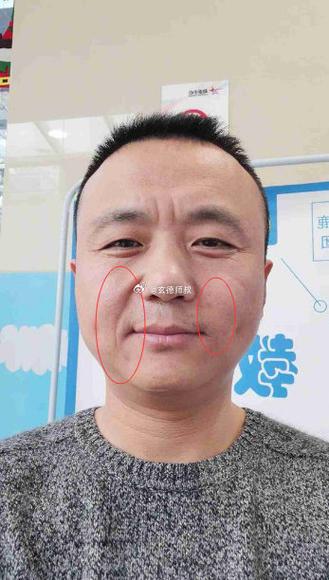 法令纹不对称面相好不好