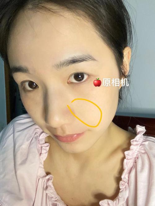 法令纹好不好 玻尿酸填充法令纹好不好