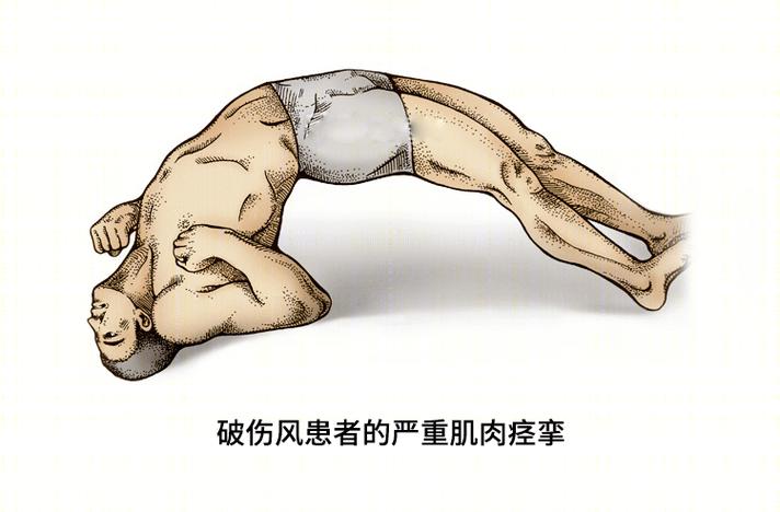 梦见破伤风周公解梦,梦见破伤风是什么意思?