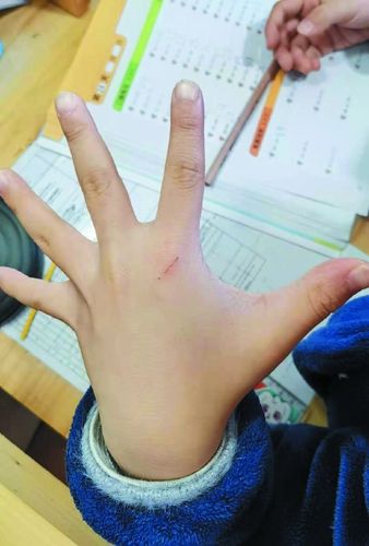 梦见自己小孩被猫抓伤