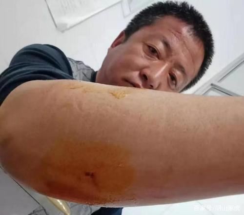 梦见被狼咬伤手臂