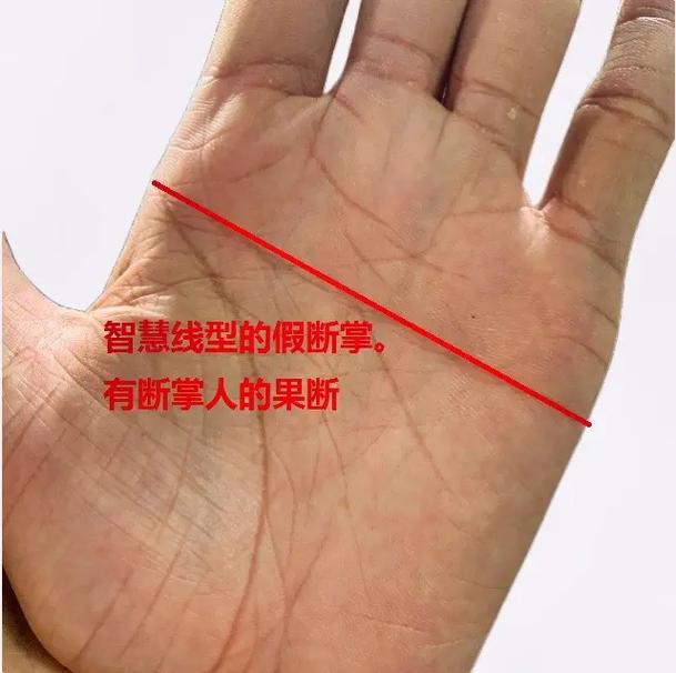 假断掌是什么意思?假断掌是不是断掌?