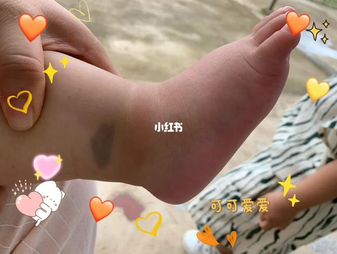 脚上有胎记代表什么