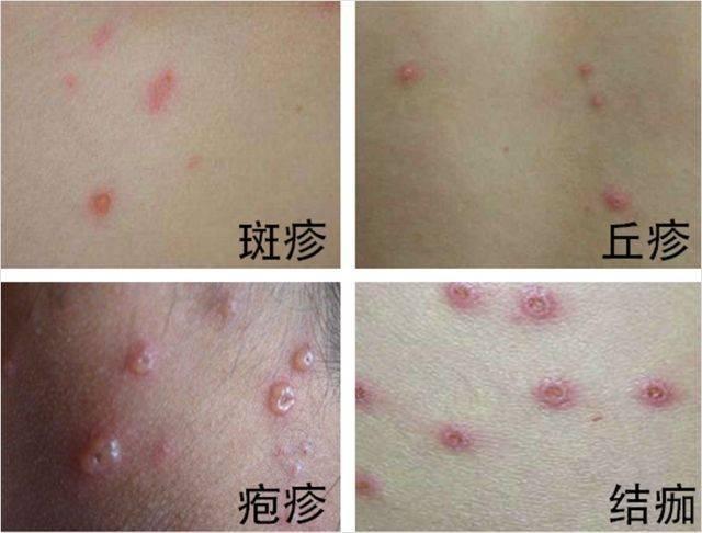 梦见传染病什么预兆