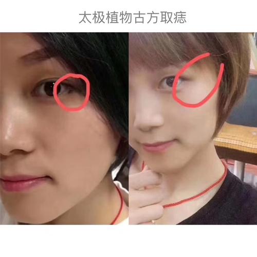 鼻子上的肉痣可以点掉吗