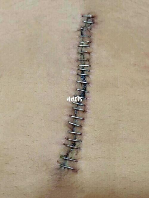巴中剖腹产选日子