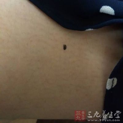 男人大腿有痣是富贵痣