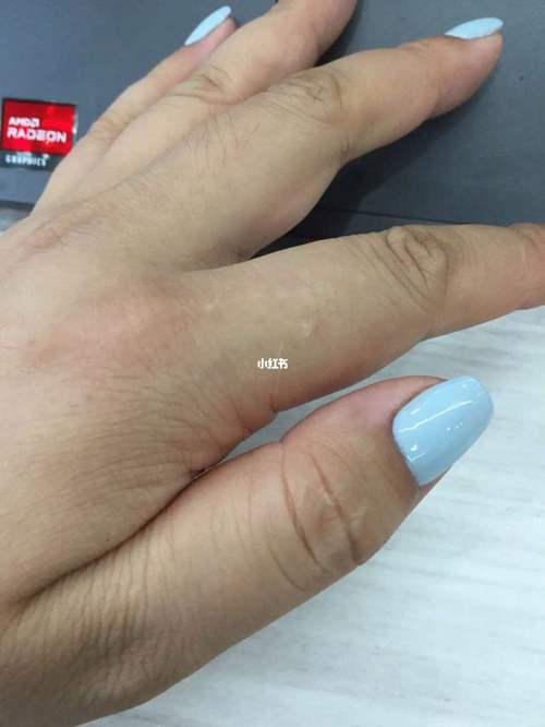 手指上面有疤痕会对运势造成影响吗