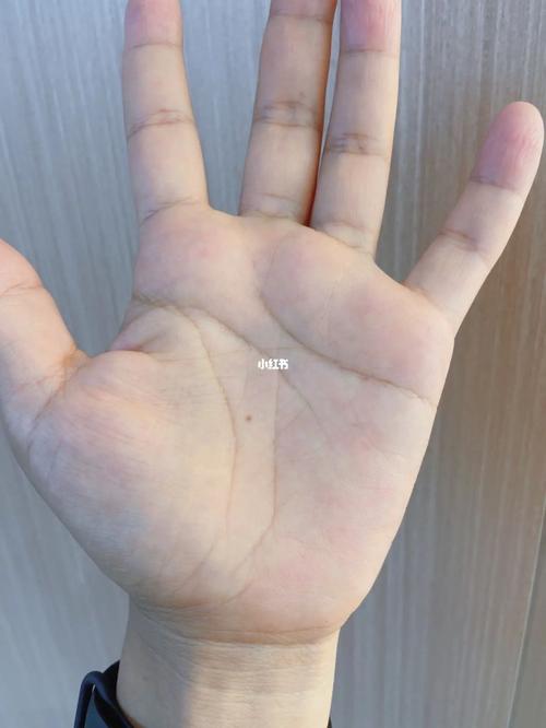 手心突然长黑痣说明什么