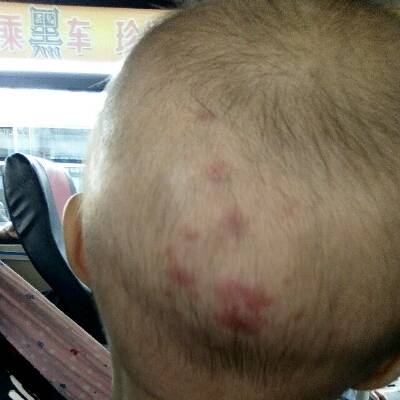 梦见头长疮怎么回事