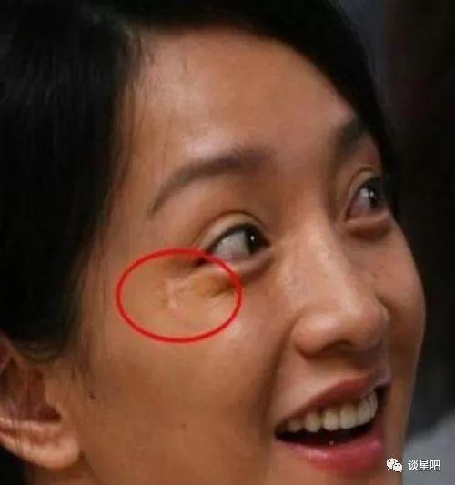 眼睛周围有疤痕影响运势吗