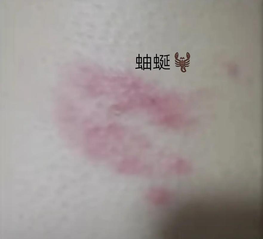 梦见毒虫咬自己头是什么意思