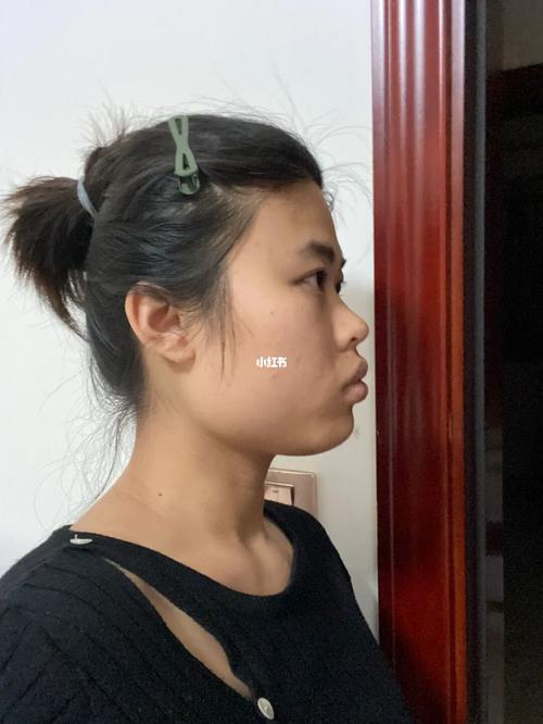 下巴突又弯会有怎样的影响呢