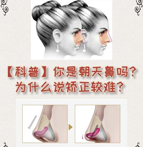 解析婴儿朝天鼻该怎么矫正