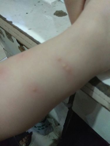 梦见苍蝇咬自己的小腿有什么预兆?