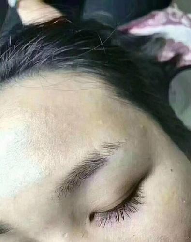 眉毛有疤痕影响运气吗