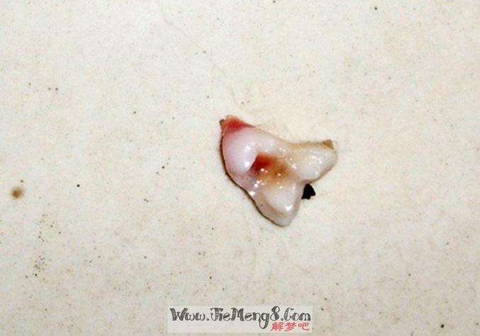 梦见牙齿掉了一部分