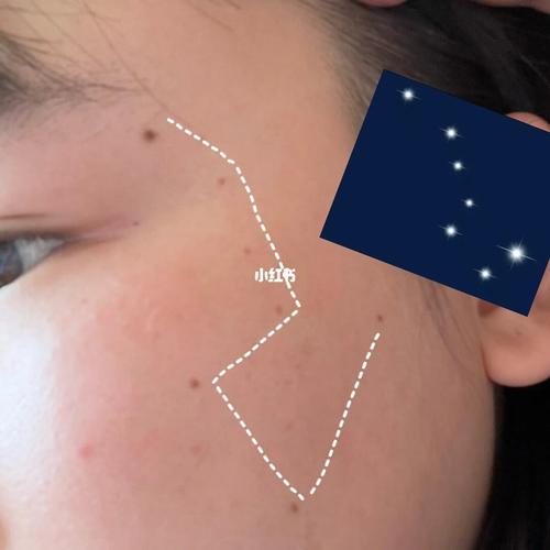 七星痣一般在什么地方