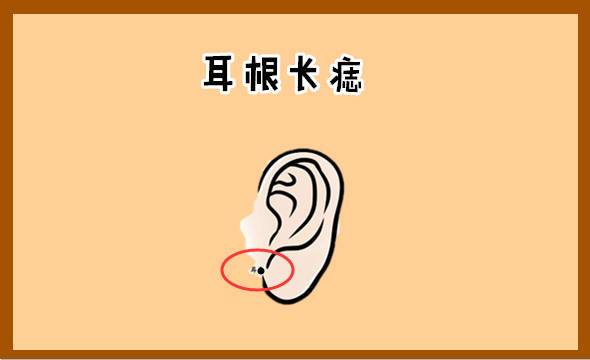 耳根有痣的正确位置图
