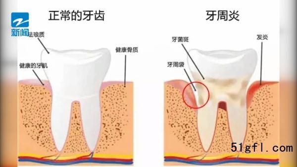 梦见牙垢掉了 周公解梦之梦到牙垢掉了