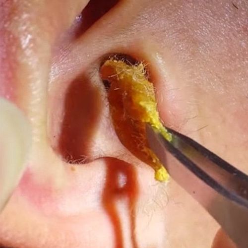 梦见挖出耳屎