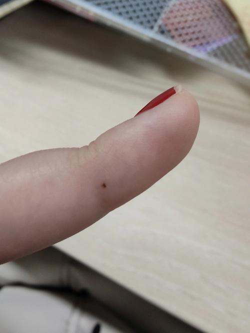 女人右脚中趾长痣代表什么