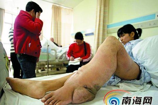 梦见一般的截肢手术好吗
