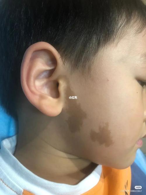 孩子身上有胎记好不好?长在身上的胎记代表什么?
